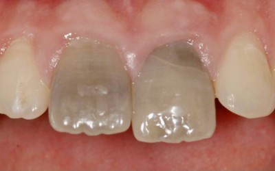 Tooth Discolouration: Why and how to fix your smile.