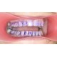   VisionButler Pink  Medium Dental Retractor