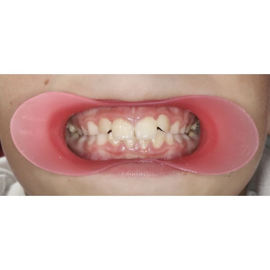   VisionButler Pink  Medium Dental Retractor