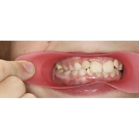    VisionButler Pink Small Dental Retractor