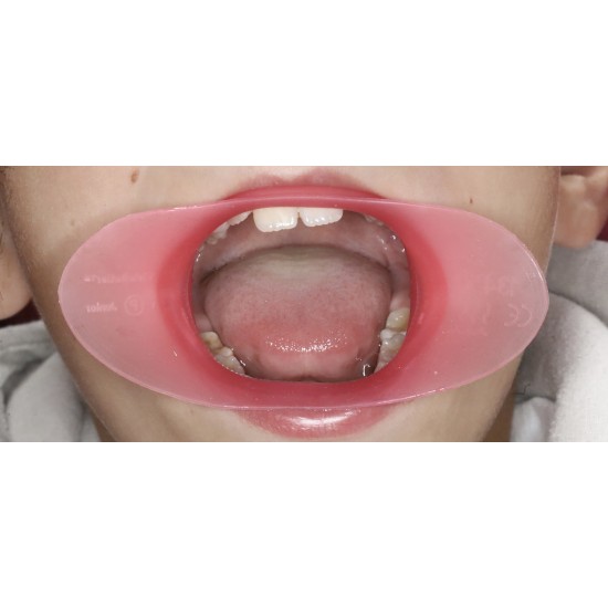    VisionButler Pink Small Dental Retractor