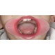    VisionButler Pink Small Dental Retractor