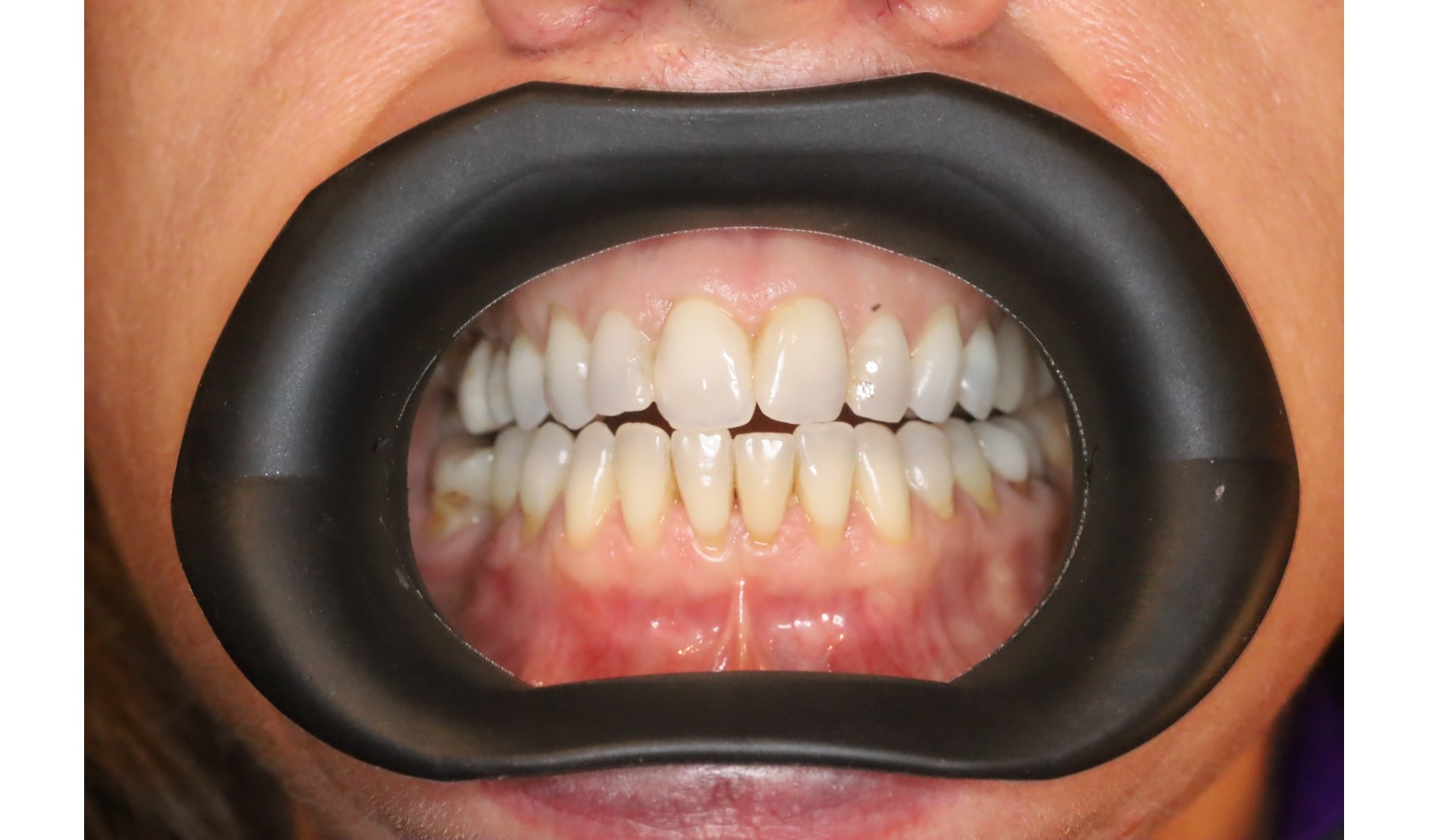 VisionButler, OptraGate, Cheak and lip rectactor, Black silicon,