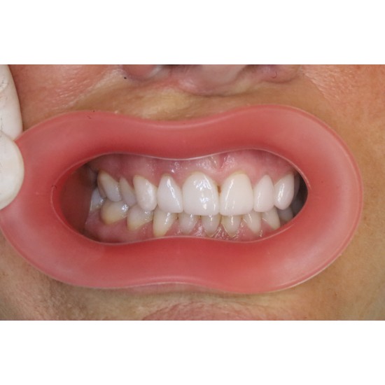   VisionButler Pink  Medium Dental Retractor