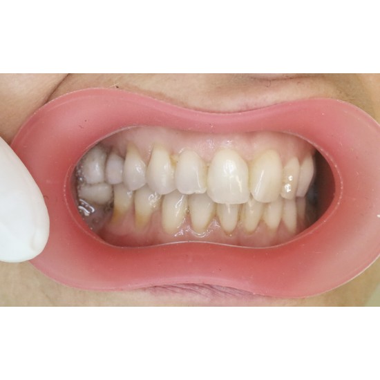  VisionButler Combo Pack x5 (Pink Medium)