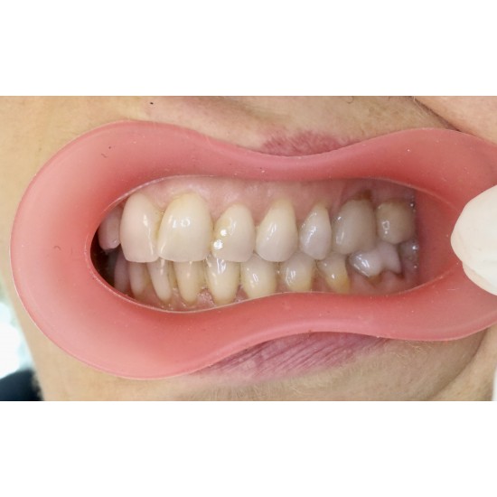  VisionButler Combo Pack x5 (Pink Medium)