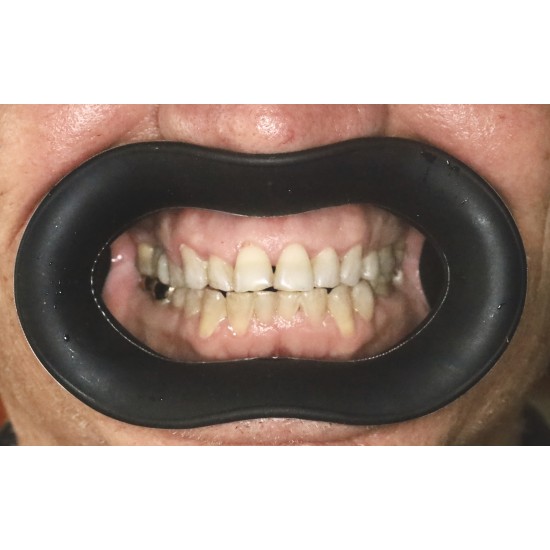  VisionButler Large Black Dental retractor