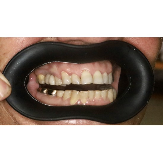  VisionButler Large Black Dental retractor