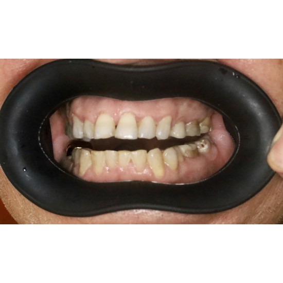  VisionButler Large Black Dental retractor