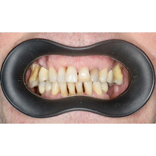  VisionButler Black Combo Pack x3  (Small Medium Large)