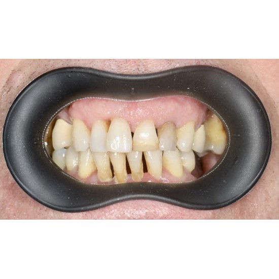  VisionButler Black Combo Pack x3  (Small Medium Large)