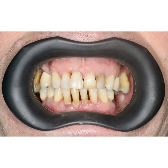  VisionButler Black Combo Pack x3  (Small Medium Large)