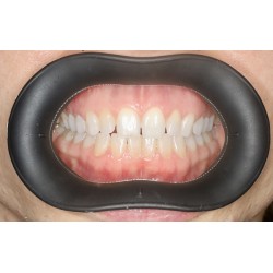  VisionButler Medium Black Dental Retractor