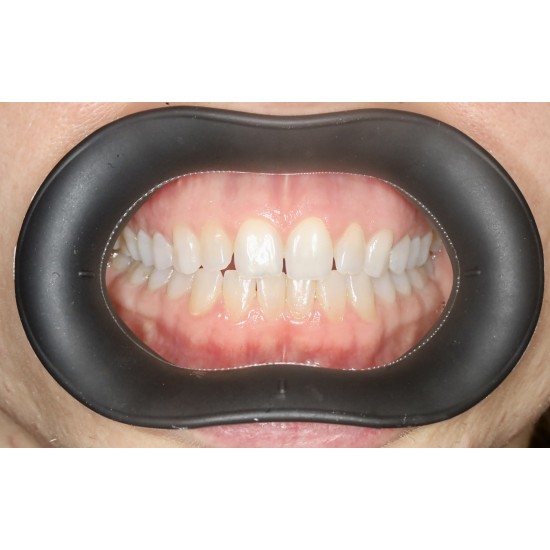  VisionButler Combo Pack x5 (Black Medium)