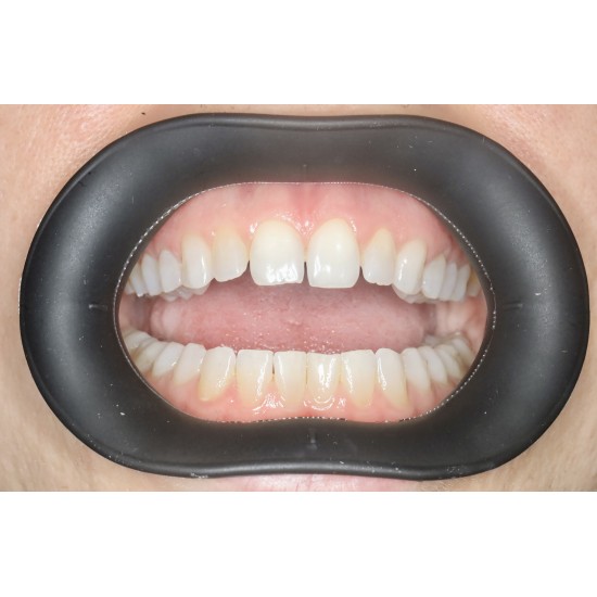  VisionButler Combo Pack x5 (Black Medium)