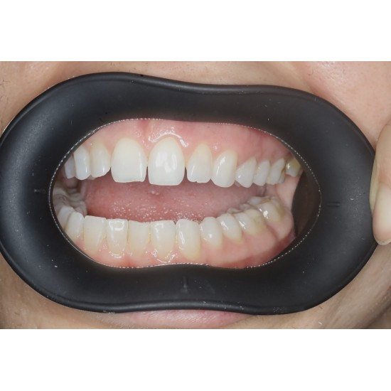  VisionButler Combo Pack x5 (Black Medium)