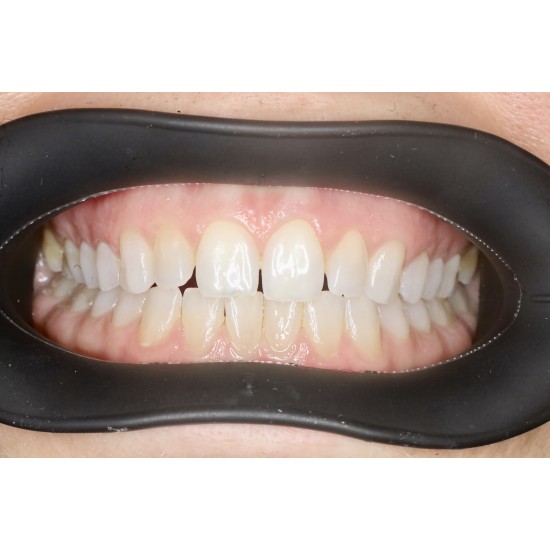  VisionButler Combo Pack x5 (Black Medium)