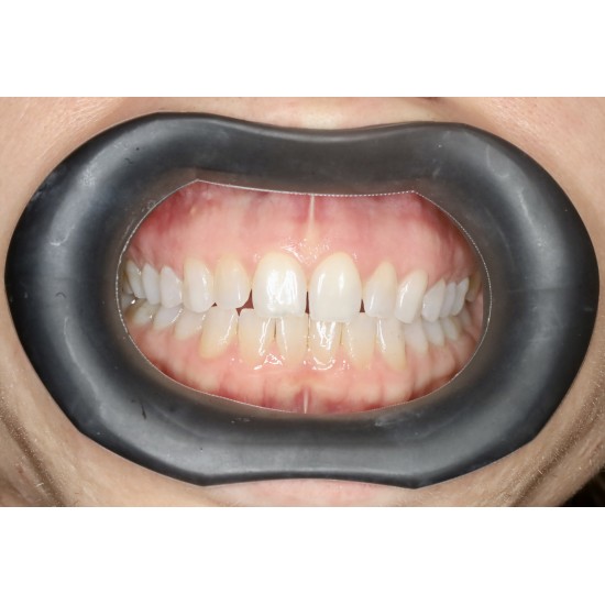  VisionButler Black Medium  Original Dental Retractor