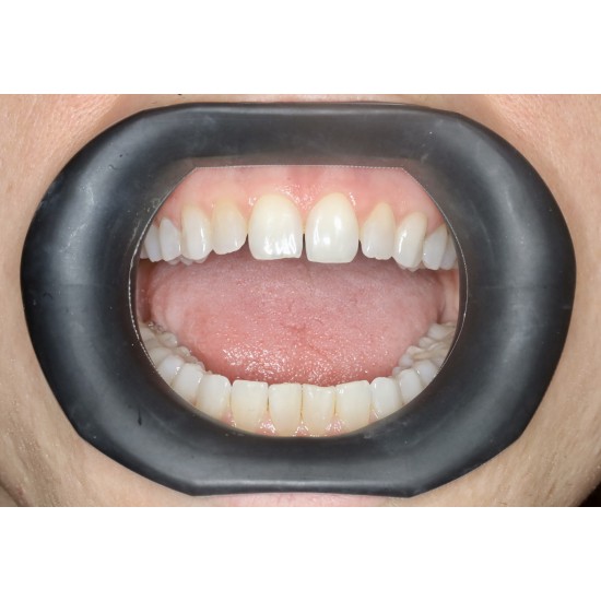  VisionButler Black Medium  Original Dental Retractor