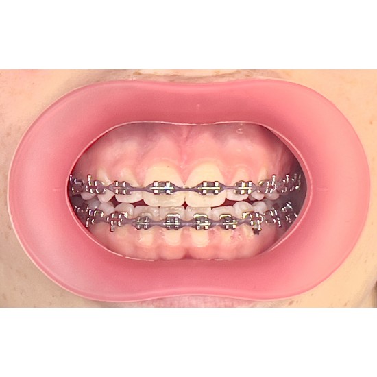   VisionButler Pink  Small Dental retractor
