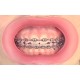   VisionButler Pink  Small Dental retractor