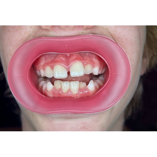   VisionButler Pink  Small Dental retractor
