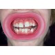   VisionButler Pink  Small Dental retractor