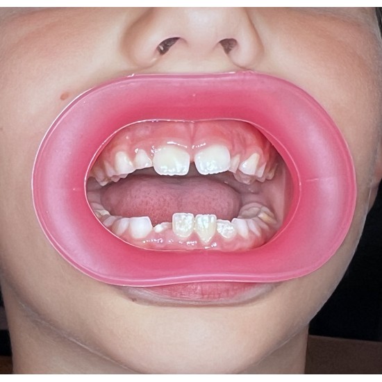   VisionButler Pink  Small Dental retractor