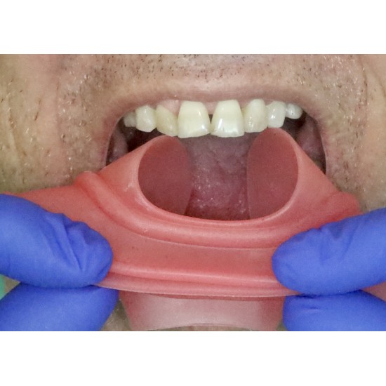   VisionButler Pink Large Dental retractor