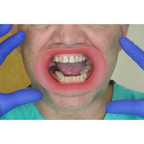   VisionButler Pink Large Dental retractor