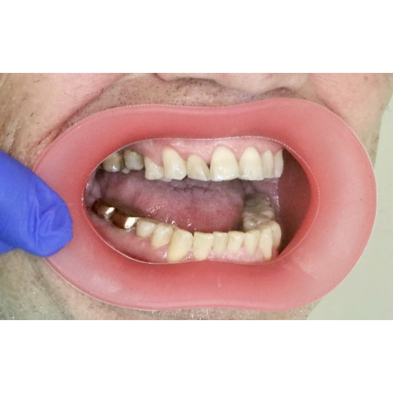   VisionButler Pink Large Dental retractor