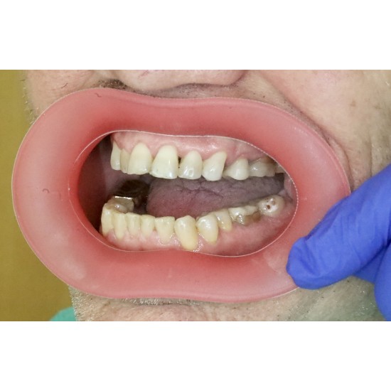   VisionButler Pink Large Dental retractor