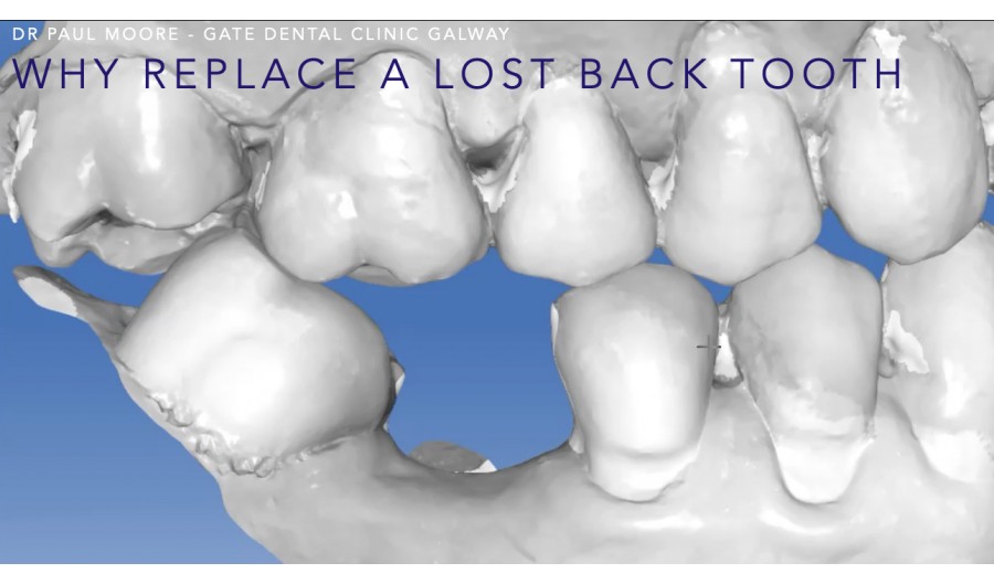 Why and how should you replace a missing tooth