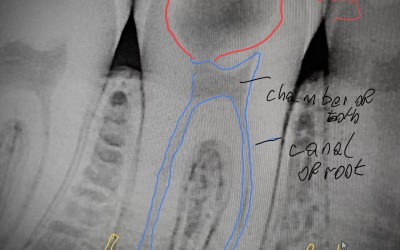 Why do Dentists take x-rays