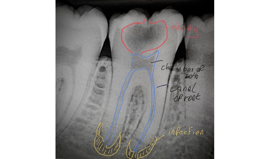 Why do Dentists take x-rays